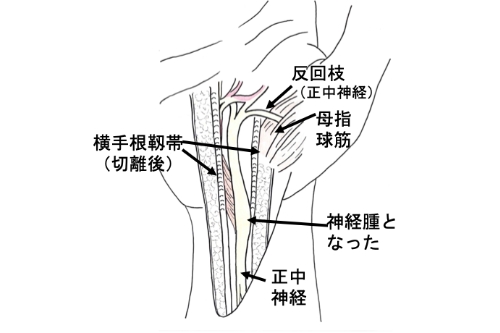 手根管症候群